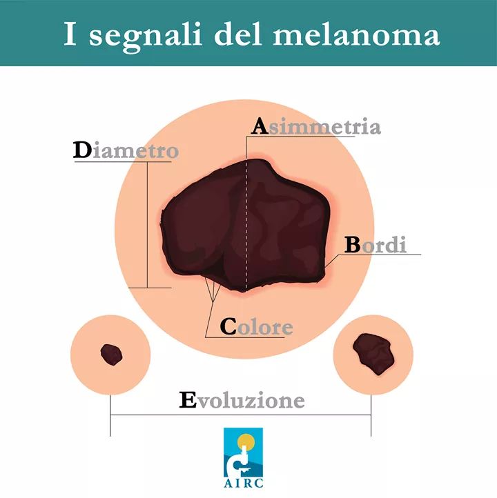 Come riconoscere il melanoma